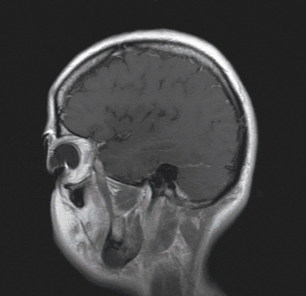 Neurinom-Gehirn Neurinom-Gehirn